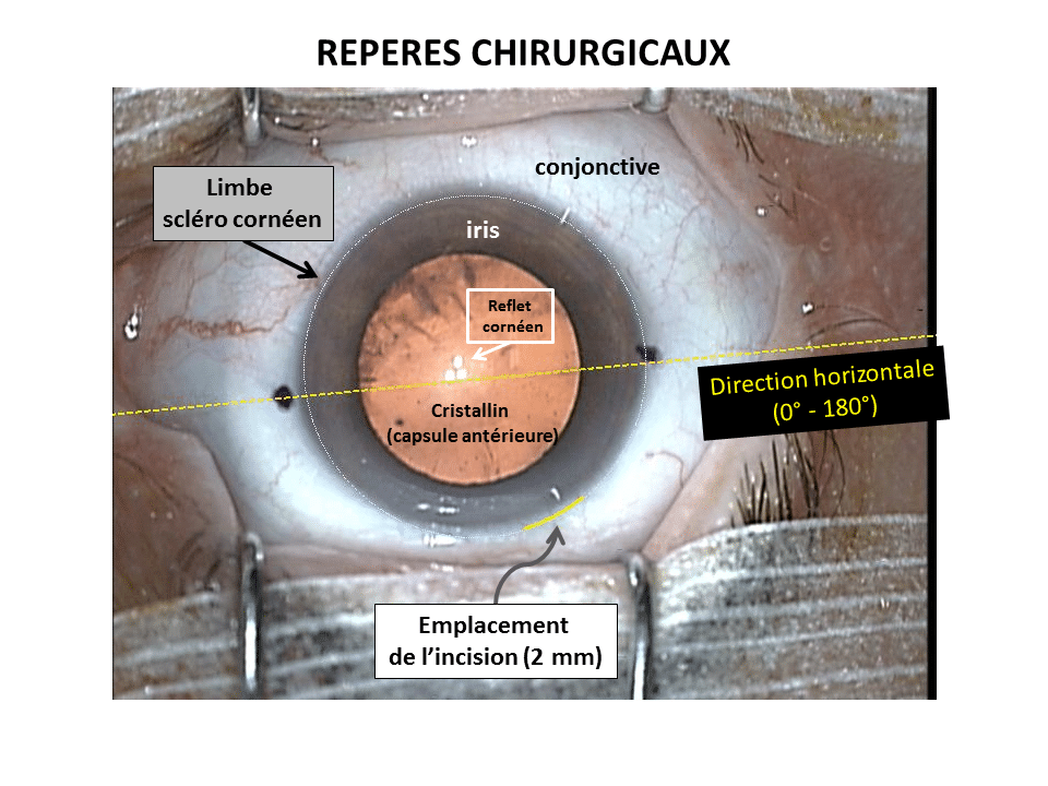 découvrez tout sur l'opération de la cataracte, les étapes de l'intervention, et les conseils pour une récupération optimale et rapide.